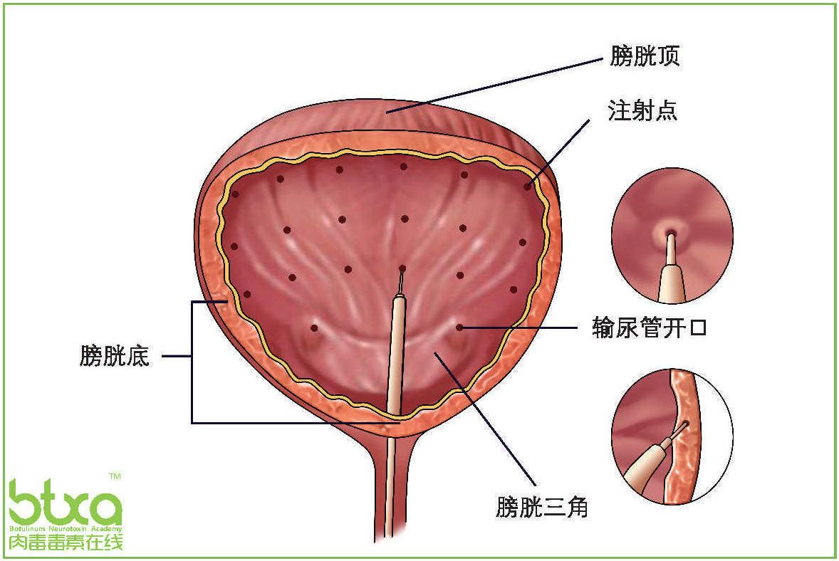 三、治療